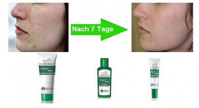Serie gegen Akne Natur-Kosmetik - effektiv gegen Pickeln, Mitesser und Narben - Wellness Gesundheit - Berlin